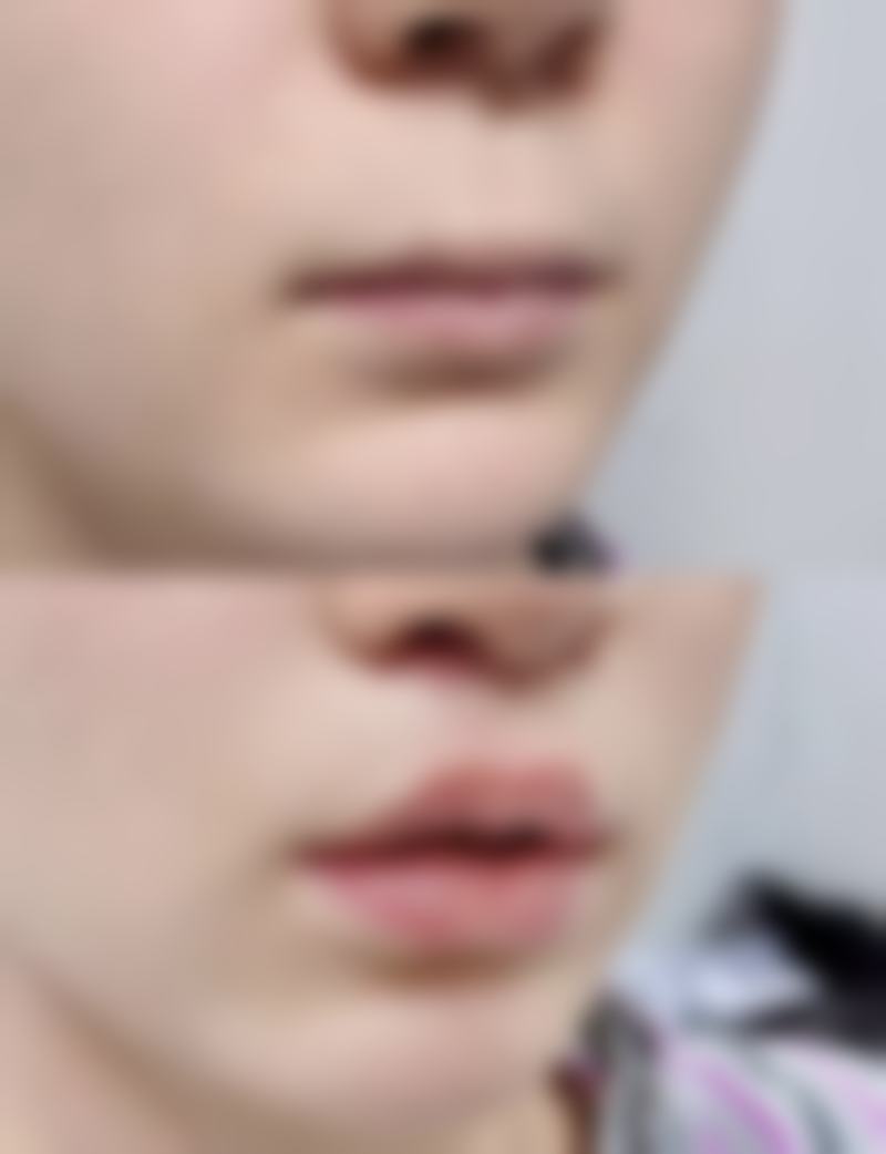 硅酮类/硅胶类药膏对疤痕疙瘩有什么作用？