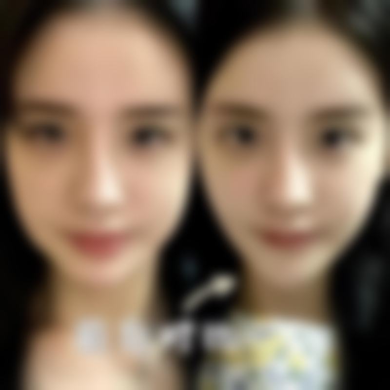 岳阳芯美医疗美容门诊部王岳华医生双眼睑技术怎么样？