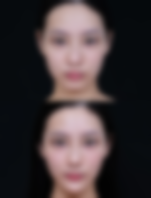 抽脂肪手术成效完全显现需要多久？