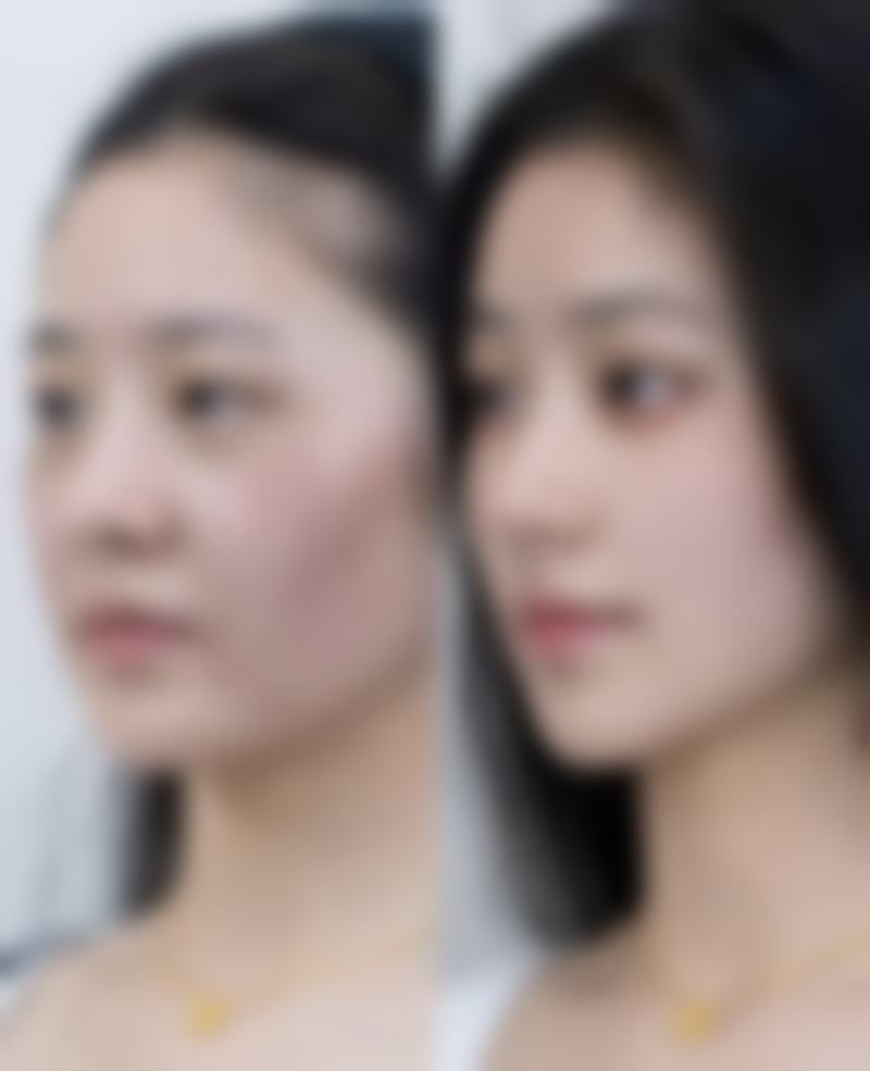 双眼皮术后的修复周期是怎样的，不对称情况会自然改善吗？