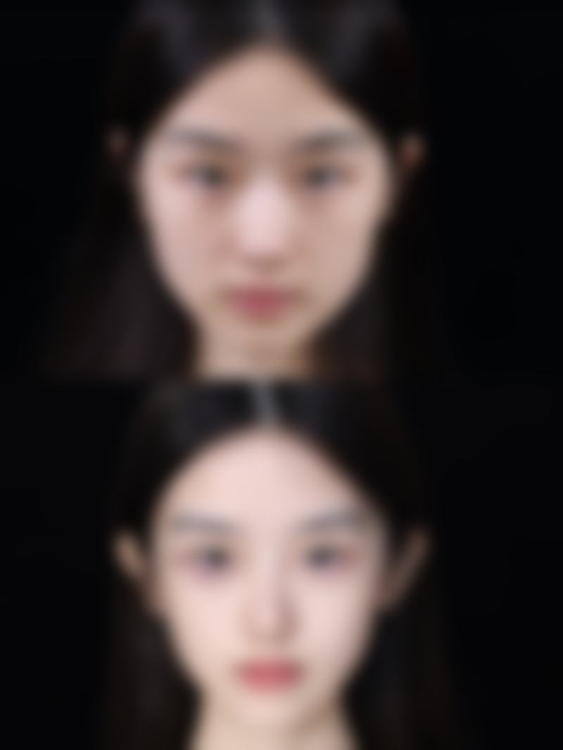 作息与眼部疲劳会导致双眼皮消失吗？