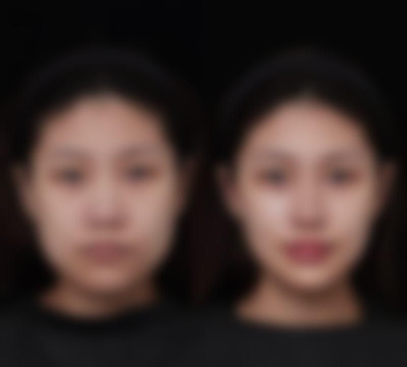 问题五：压力疗法如何修复缝合伤口的疤痕呢？