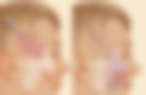 开眼角手术有哪些方式和注意事项呢？