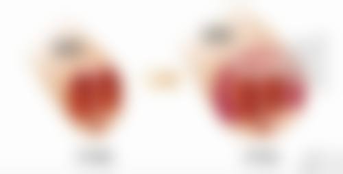 李光琴修复双眼皮怎么样？真实案例分享与术后效果解析！答案是效果自然恢复快！ 