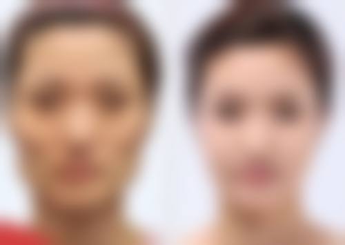 手术治疗疤痕有哪些方式呢？