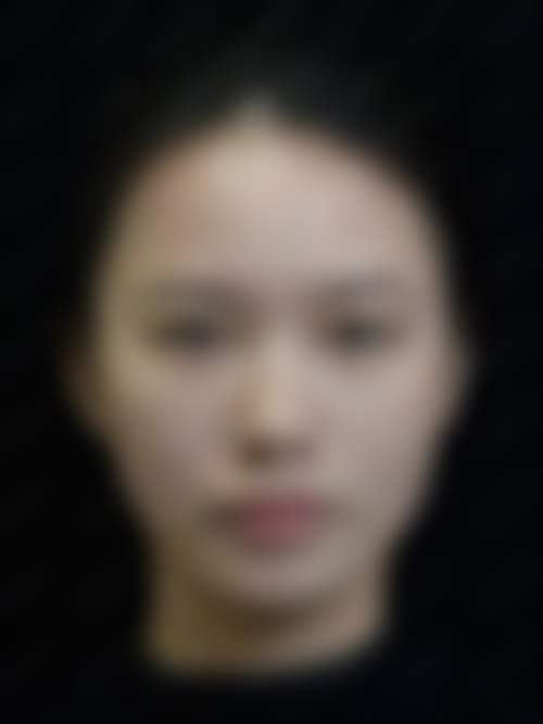 深圳阳光医疗美容医院张艳莉医生激光角膜屈光手术技术怎么样？