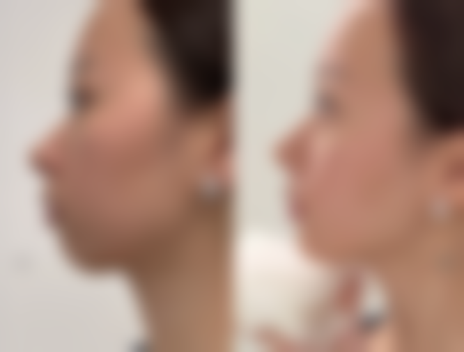 河南大学附属南石医院烧伤整形美容中 心闫静医生患者评价