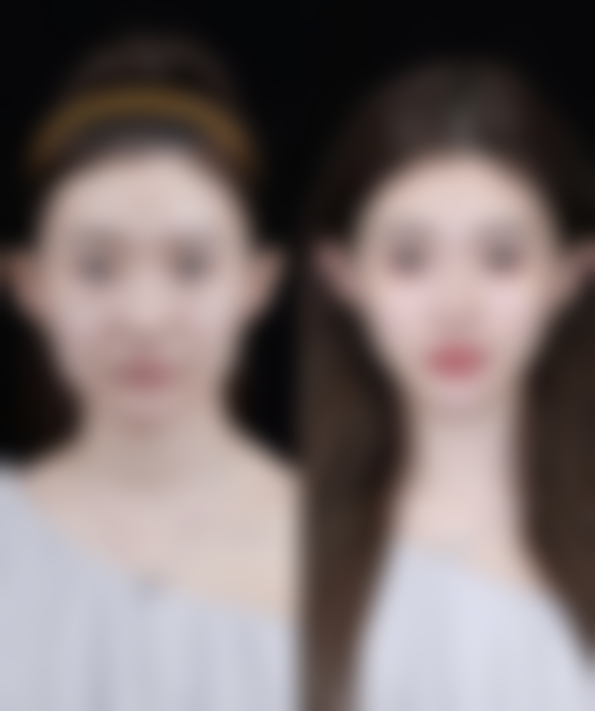 不对称双眼皮修复实例成效如何？