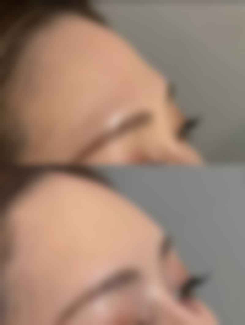 疤痕修复有哪些药物治疗方法呢？