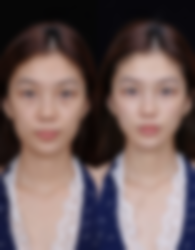 韩国MGTY整形外科朴正宪医生眼部综合整形技术怎么样？