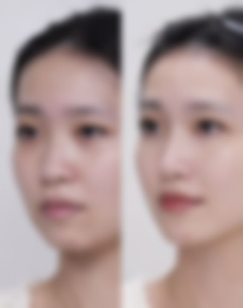 疤痕有哪些类型呢？