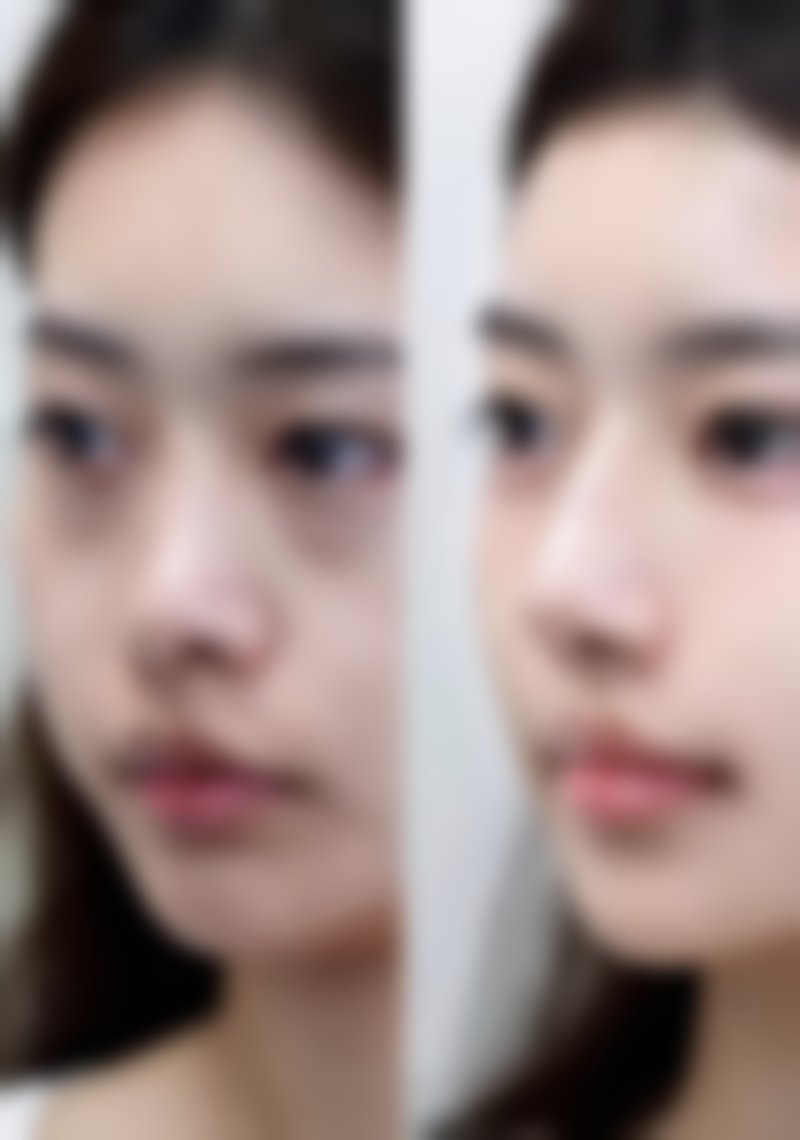 疤痕真的无法完全去除吗？