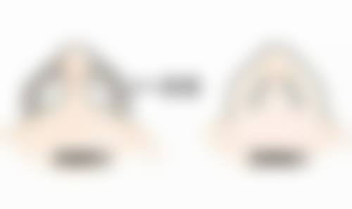 盐水热敷法是如何去除下眼袋的？