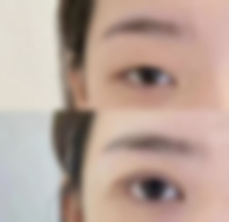 除了这5种核心方法，还有其他去除下眼袋的方法吗？