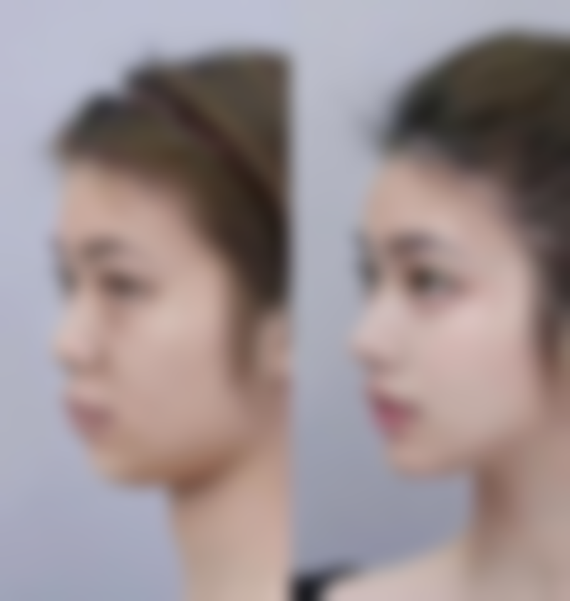 是不是所有人都适合打瘦脸针呢？