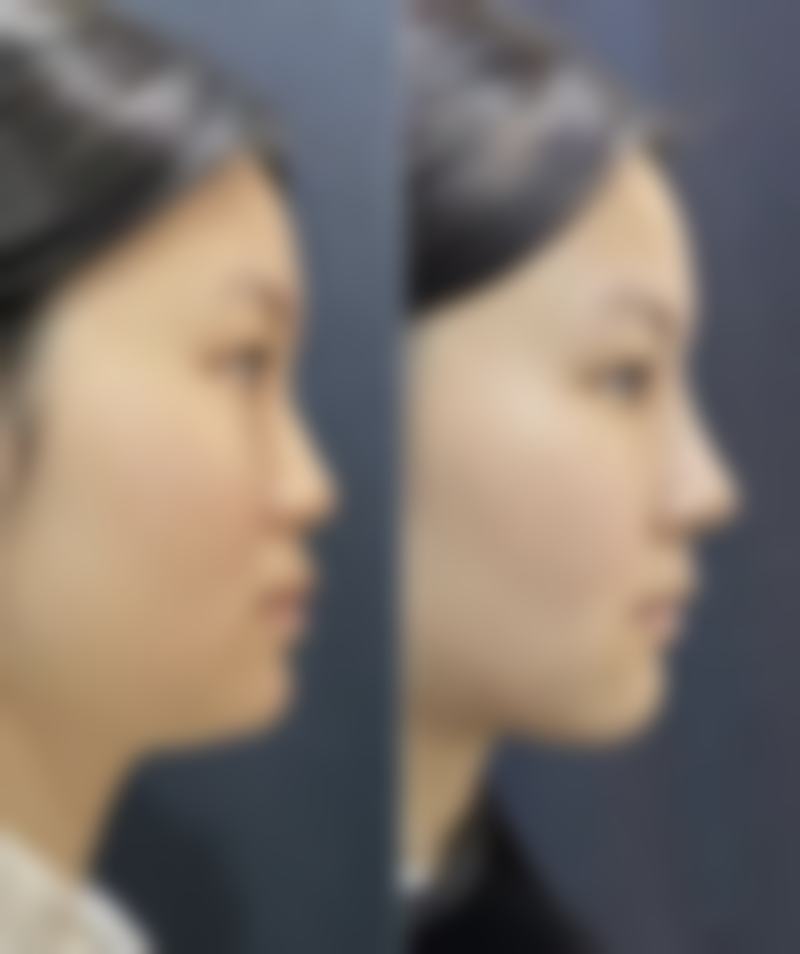 打瘦脸针怀孕了怎么办？专家告诉你如何安全应对！胎儿会受影响吗，后续产检要注意啥？ 