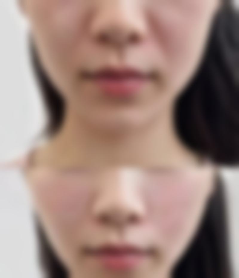 哪些因素会影响疤痕修复成效？