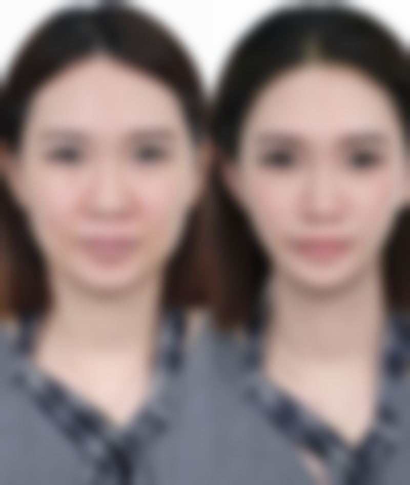 瘦脸针注射后多久能看到矫正成效，成效能维持多久呢？