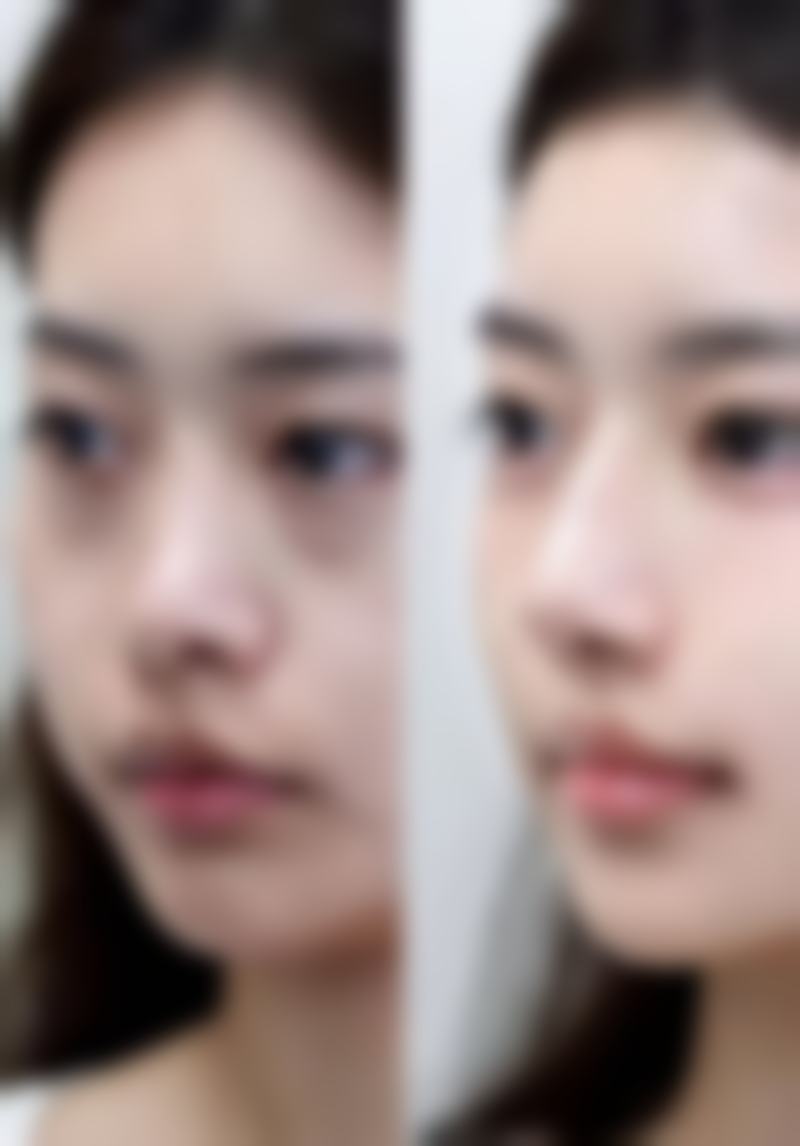 青少年抽脂手术的潜在益处