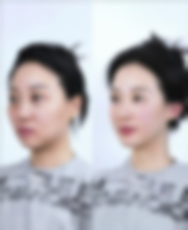 瘦脸针一针成效能维持多久呢？