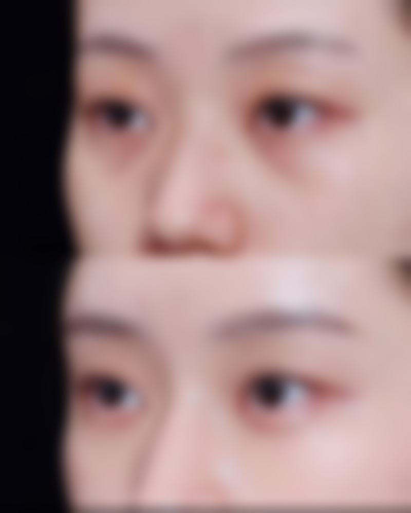 割双眼皮可以睡觉吗？揭秘术后护理与恢复的关键要点！术后多久能正常用眼？ 