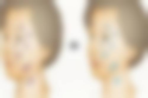 韩国815抗衰老中 心朴性垠医生埋线提升技术怎么样？