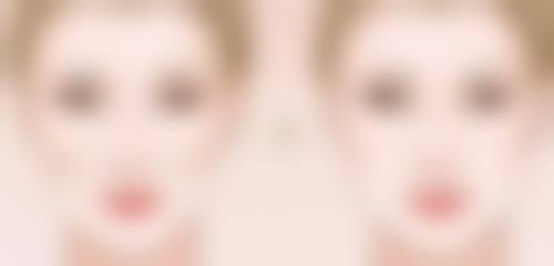 隆鼻术后需要注意什么？