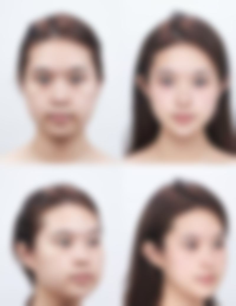 线提升/埋线隆鼻适合哪些人？