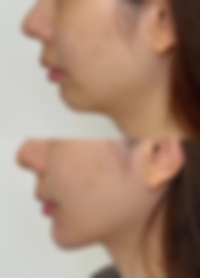 双眼皮术后可以马上打除皱针吗？
