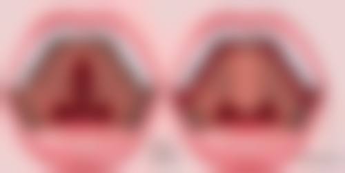 疤痕疙瘩怎么治不复发？专家分享5个有效方法，助你重拾自信！这些方法适合哪些人群？ 