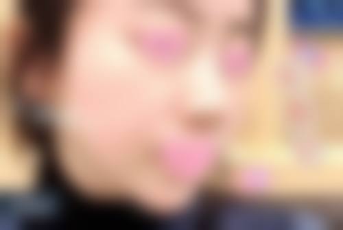耳软骨隆鼻在供区（耳部）会有哪些并发症？