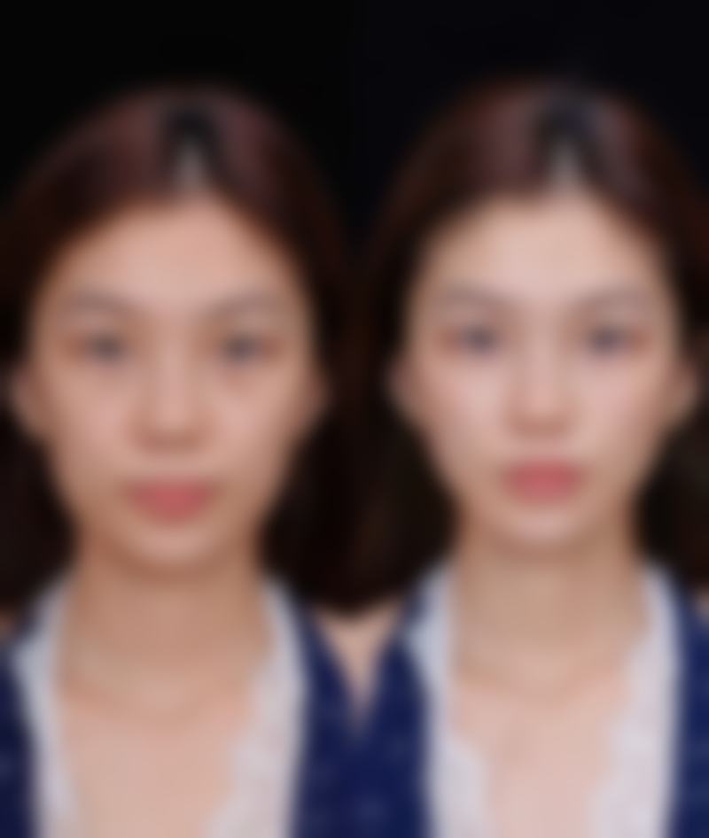 怎样降低丰太阳穴的风险呢？