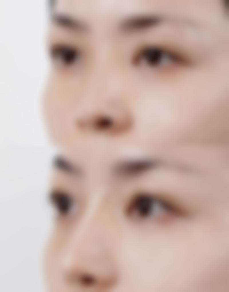抽脂手术会有哪些局部损害呢？