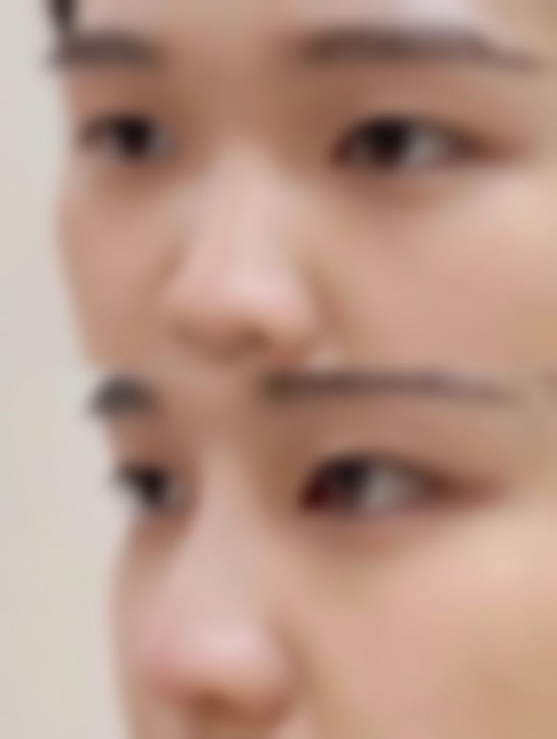宜昌华美整形美容医院罗广杰医生隆鼻技术怎么样？