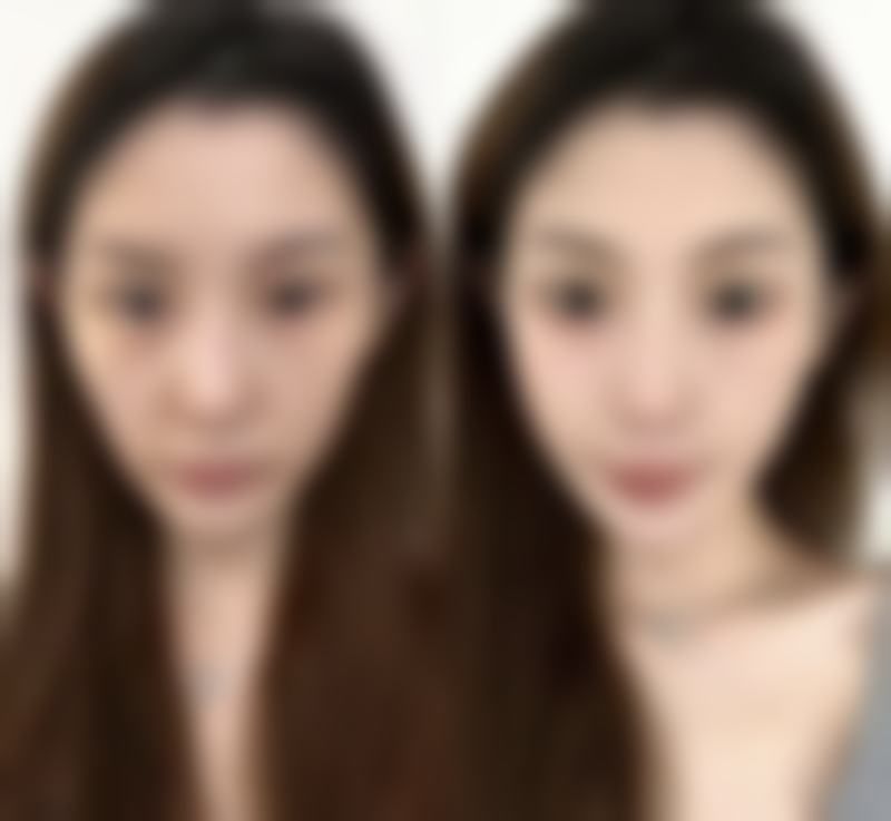 厦门思明瑞麒麟医疗美容诊所悦白17型胶原适合哪些人呢？
