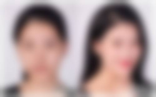 厦门思明瑞麒麟医疗美容诊所润致·娃娃针能带来怎样的成效？