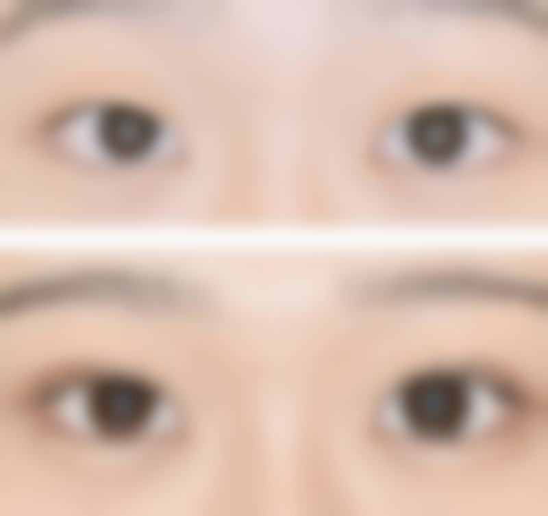 疤痕妊娠保守治疗成功的核心指标有哪些?
