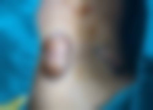 居家护理剖腹产疤痕该选什么产品?怎么用?