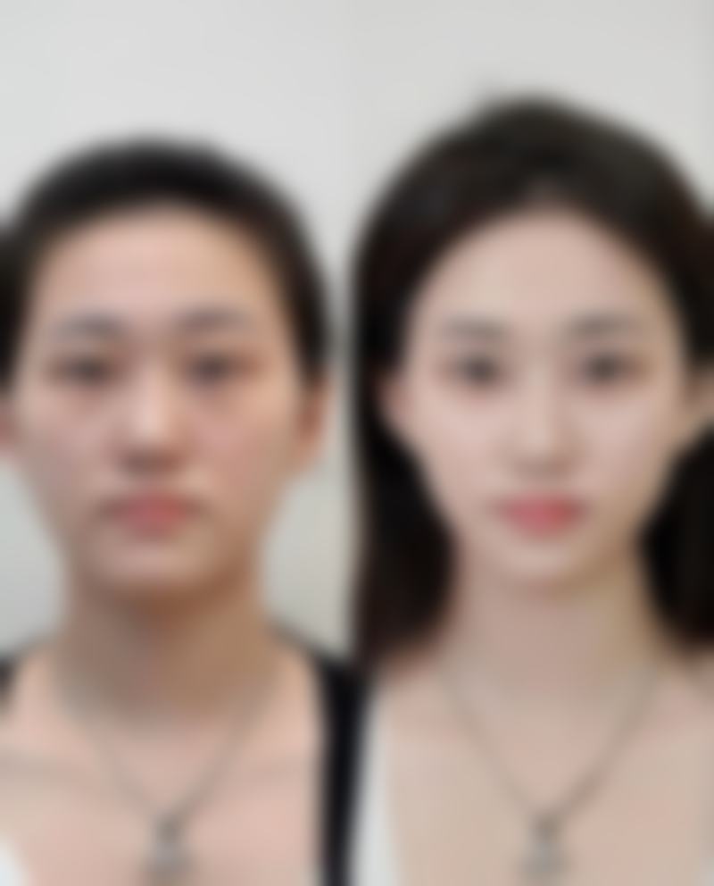 医美修复剖腹产疤痕有哪些周期?