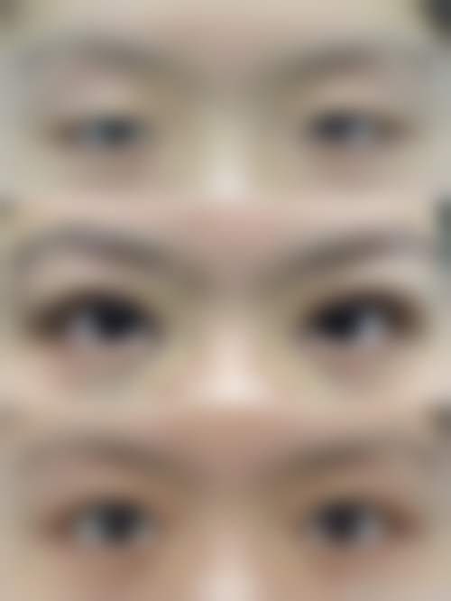 深圳阳光医疗美容医院刘光磊医生双眼皮技术怎么样?