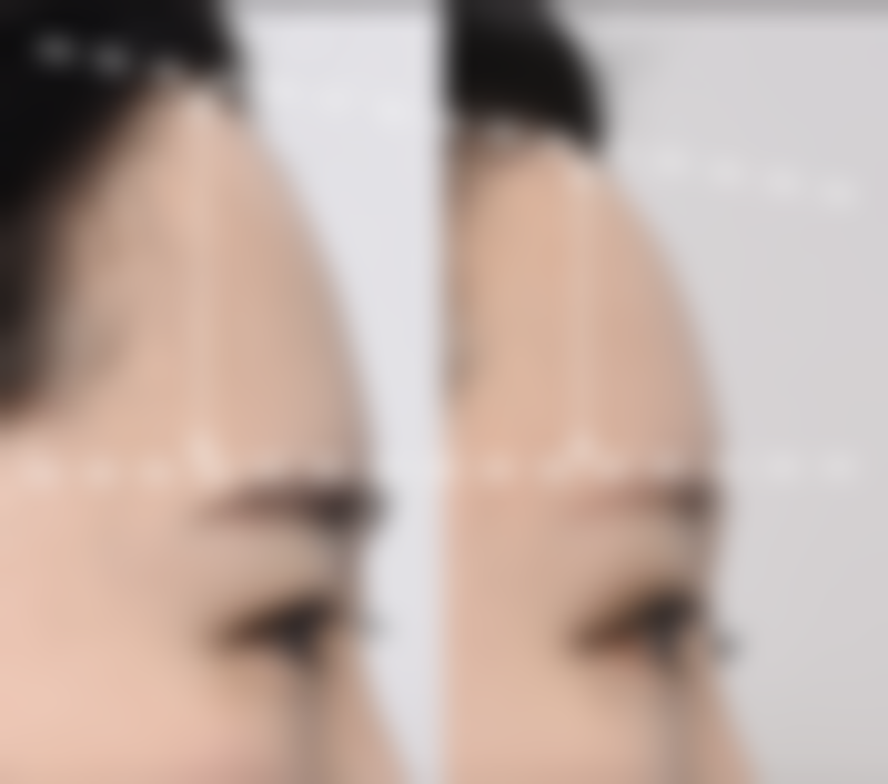 其他改善眼袋的方式