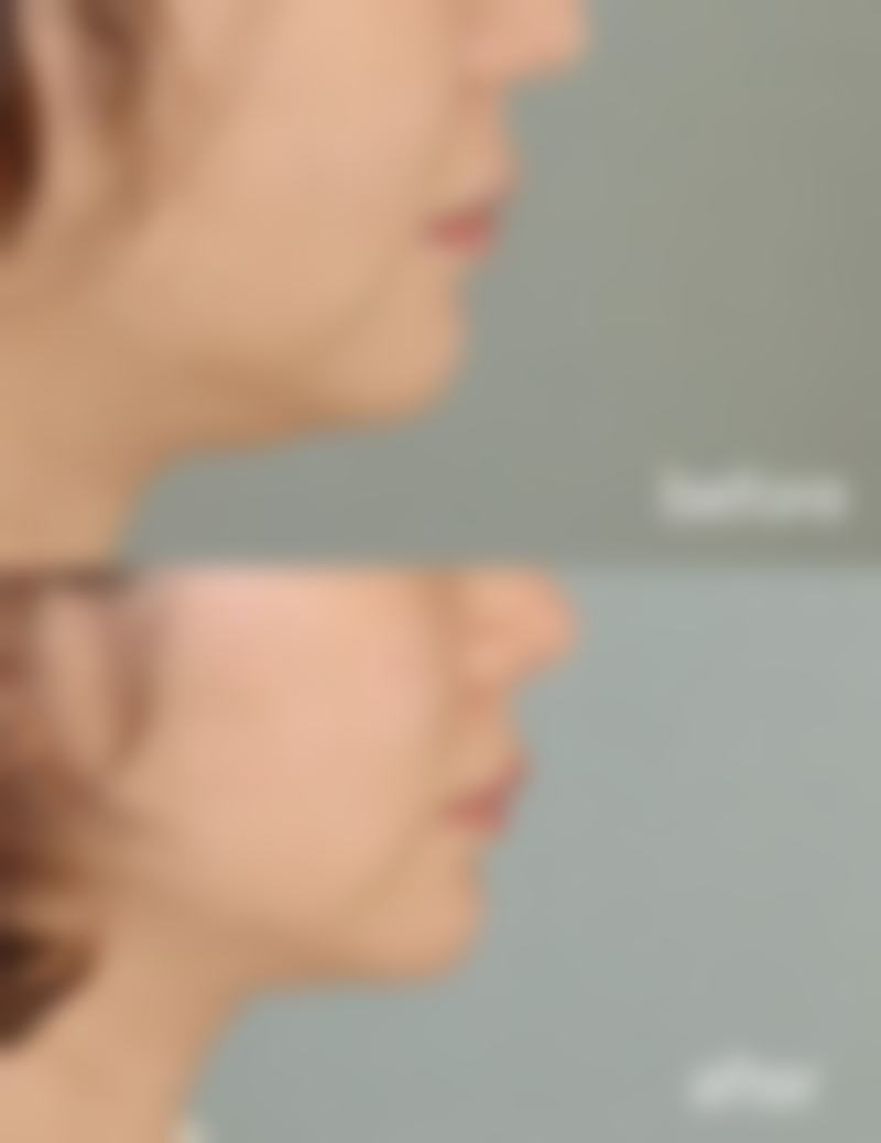 色素疤痕的改善周期是多久呢？