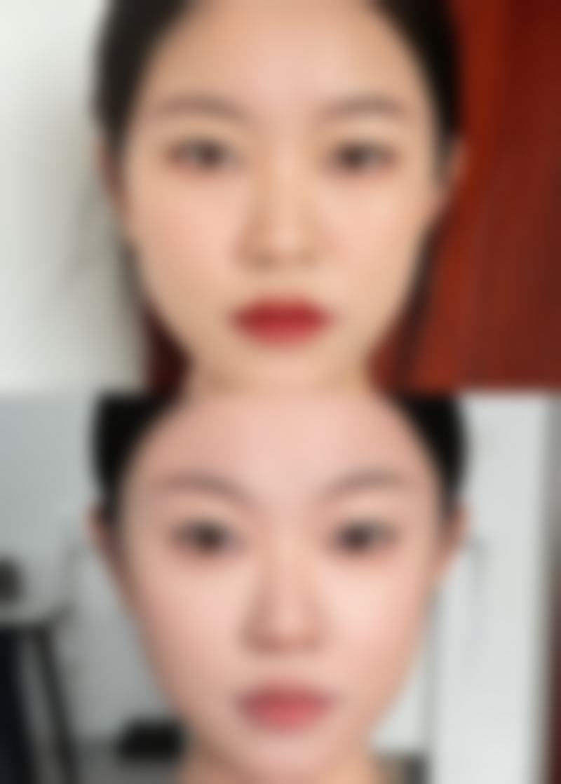假性双眼皮真的可以通过手术变成恒久性真性双眼皮吗?