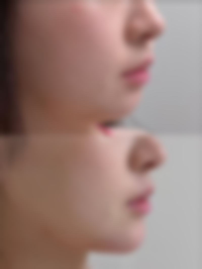 18岁后去除眼袋有什么优势和推荐手术方式?