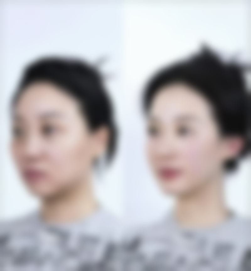 补打瘦脸针的间隔时间有什么建议呢?