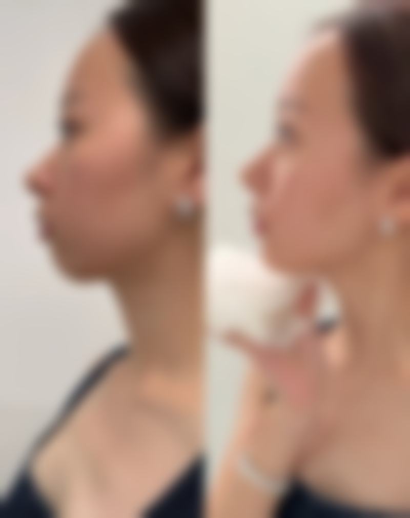 不同睡眠姿势对瘦脸成效有什么具体影响呢?
