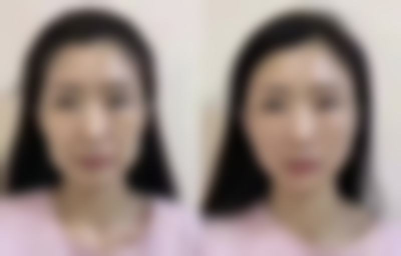 如何降低自体脂肪移植隆胸的风险?