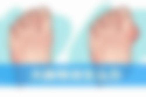 如何区分正常与异常发红的疤痕?