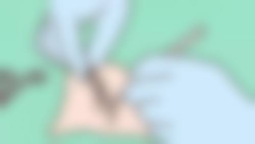 哪些人适合做双眼皮手术?