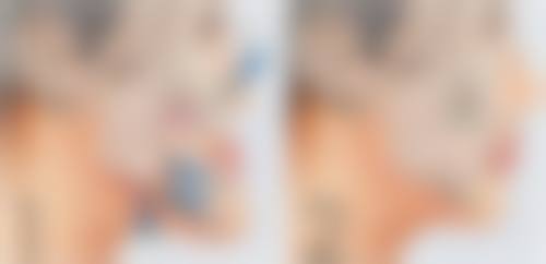 脸上烫伤疤痕怎样去除?手术治疗见成效